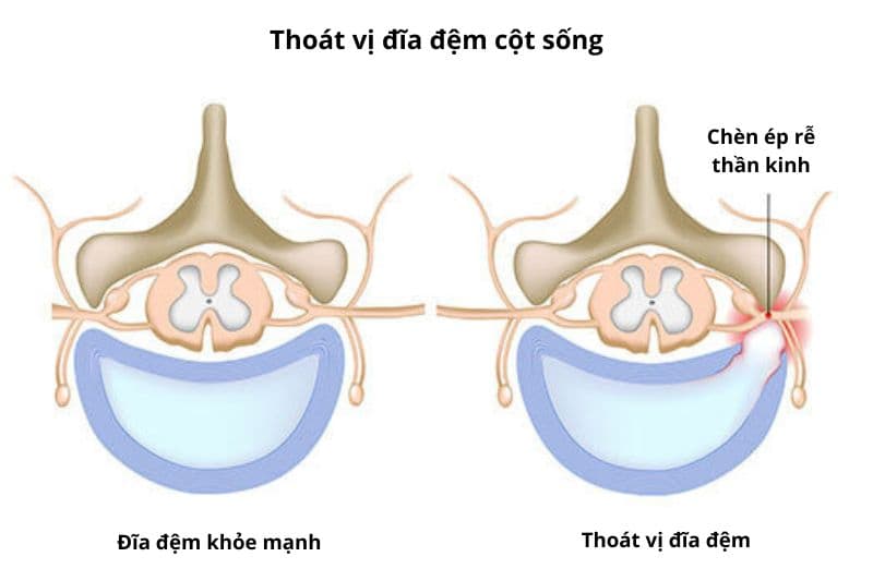 các vị trí thoát vị đĩa đệm cần biết