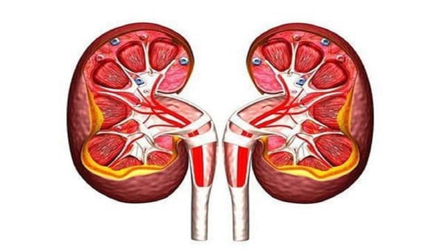 Thận ứ nước độ 2 là gì, nguyên nhân, triệu chứng và cách phòng 