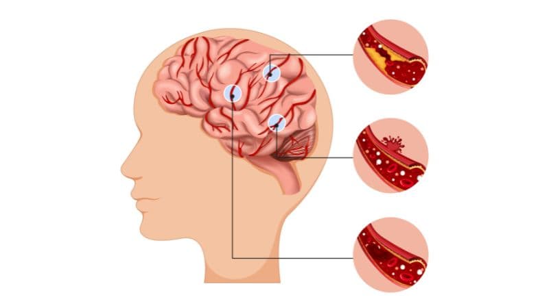 Cơ chế đột quỵ theo từng loại đột quỵ