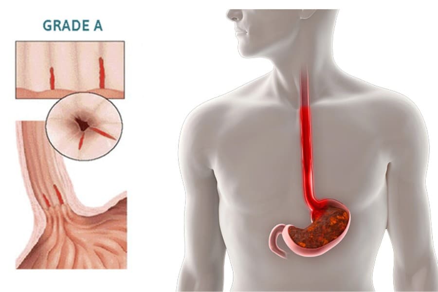 Trào ngược dạ dày độ A là mức độ nhẹ nhất trong các giai đoạn bệnh