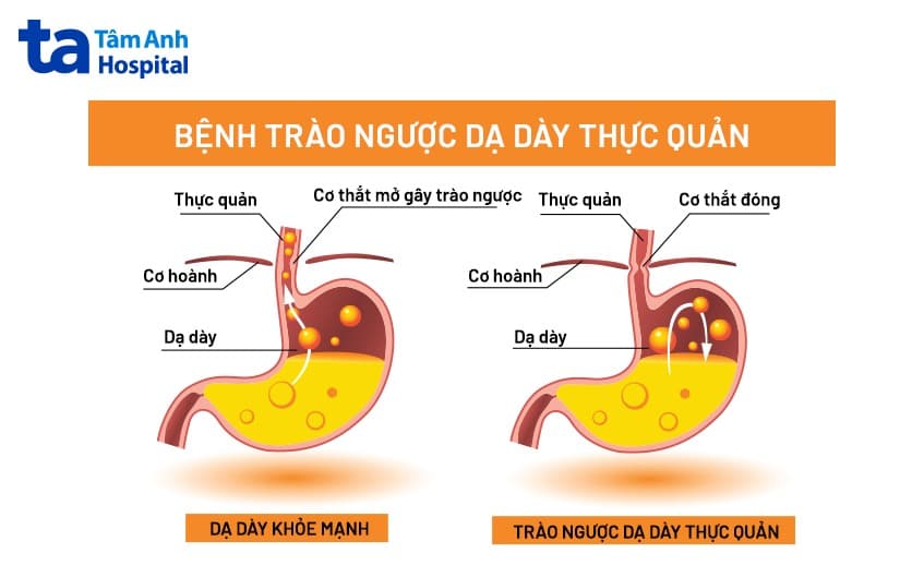 Dù độ A còn nhẹ nhưng không nên chủ quan