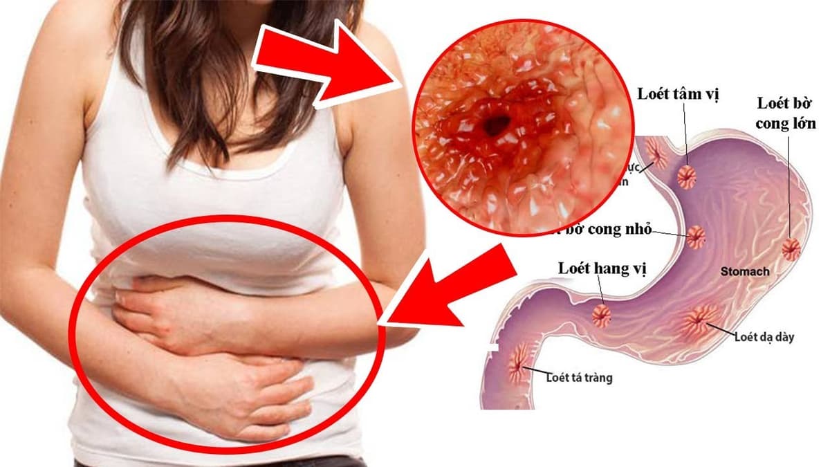 Loét dạ dày tá tràng: Nhiều hệ lụy nguy hiểm nếu không trị sớm