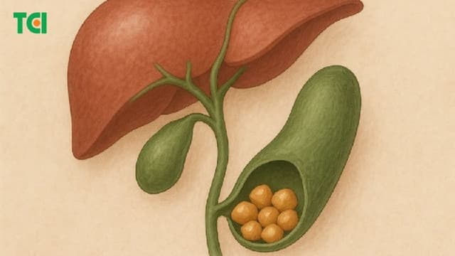 Tìm hiểu về 4 giai đoạn viêm túi mật cấp