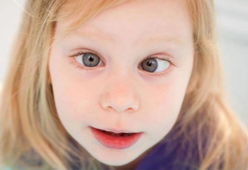 Bệnh lác mắt ở trẻ em là gì