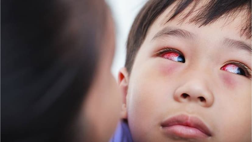 Bị đau mắt đỏ liệu có nguy hiểm không? Giải pháp điều trị dứt điểm