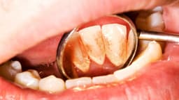 Cao răng màu đen: Dấu hiệu vấn đề răng miệng nghiêm trọng