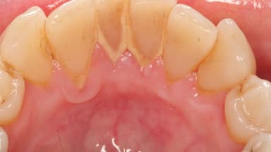 Tìm hiểu về vấn đề có nên lấy cao răng không