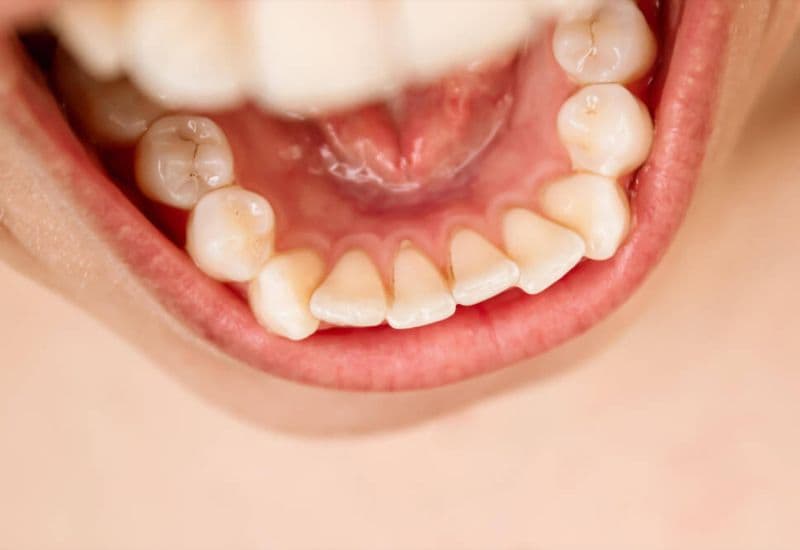 Có nên lấy cao răng không? - Cao răng là gì và vì sao cao răng hình thành?