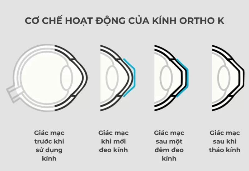 Kính Ortho K hoạt động như thế nào