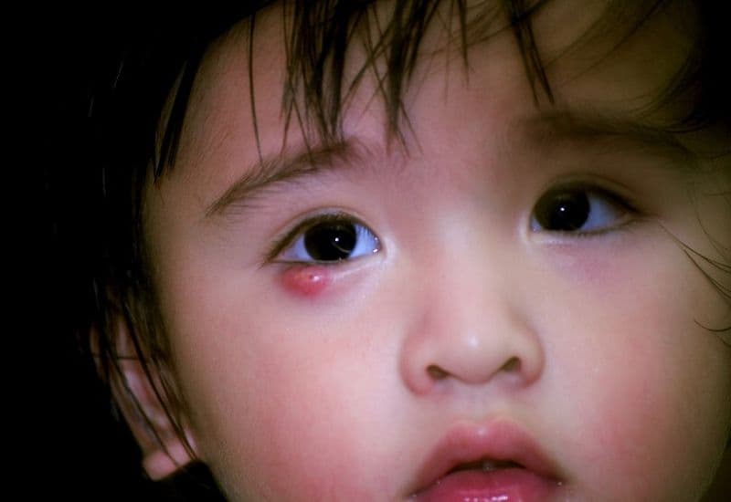 Lên lẹo mắt là bệnh gì