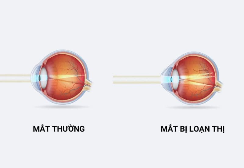 Triệu chứng loạn thị là như nào