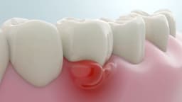 Lợi bị sưng: Dấu hiệu cảnh báo vấn đề răng miệng nghiêm trọng