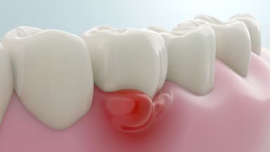 Lợi bị sưng: Dấu hiệu cảnh báo vấn đề răng miệng nghiêm trọng