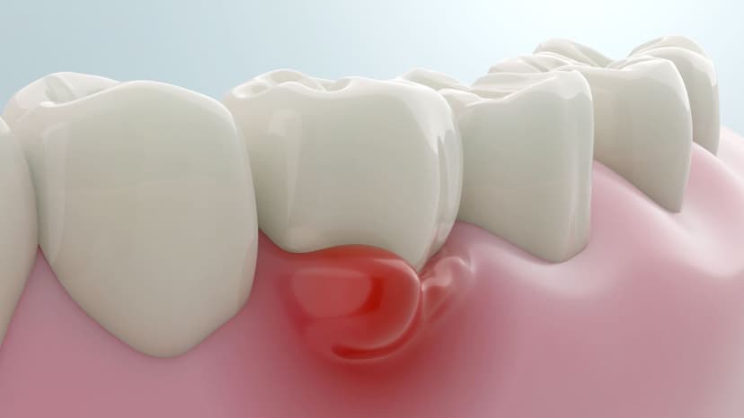 Lợi bị sưng: Dấu hiệu cảnh báo vấn đề răng miệng nghiêm trọng