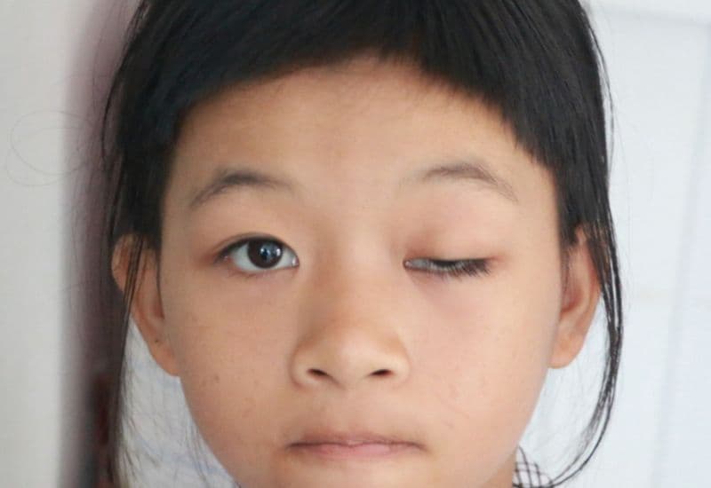 Mắt sụp mí là tình trạng mí mắt trên bị sa xuống thấp hơn vị trí bình thường