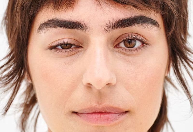 Mắt sụp mí ảnh hưởng đến thẩm mỹ