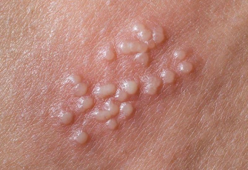 Dấu hiệu nhận diện mụn herpes