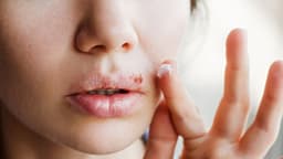Mụn herpes tái phát nhiều lần: Nguyên nhân và hướng điều trị