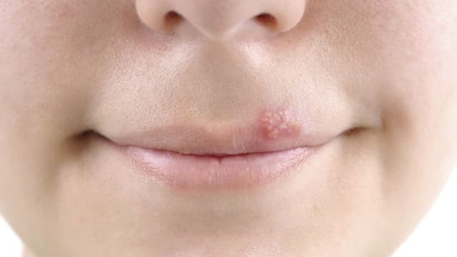 Giải mã mụn rộp ở môi: Mức độ nguy hiểm và phương pháp điều trị