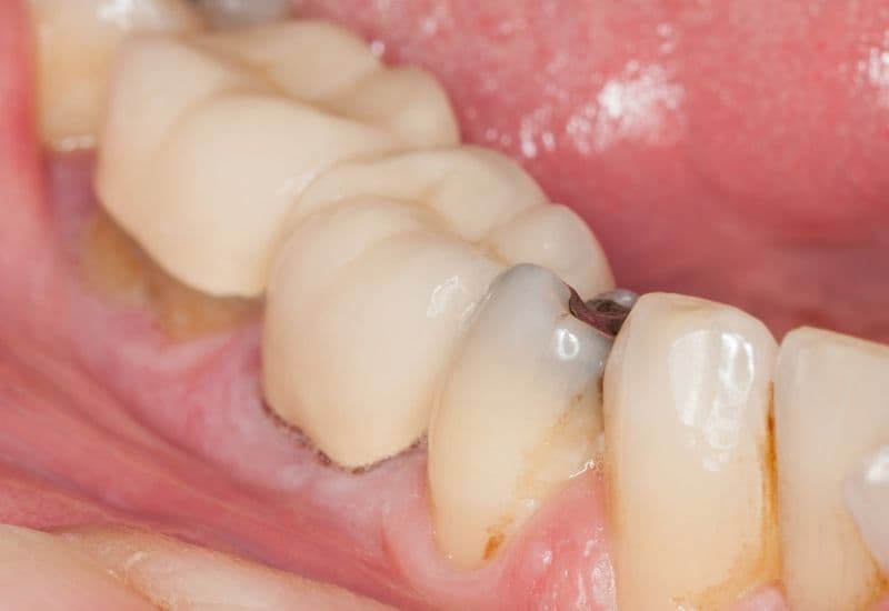 Sâu răng nhẹ đánh răng có hết không - Sâu răng nhẹ là gì và dấu hiệu nhận biết sớm