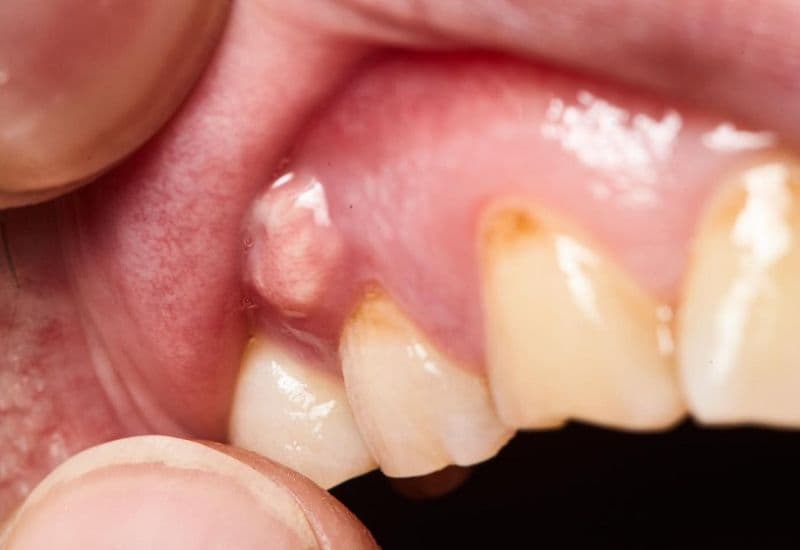 Nhận biết sưng lợi hàm trên