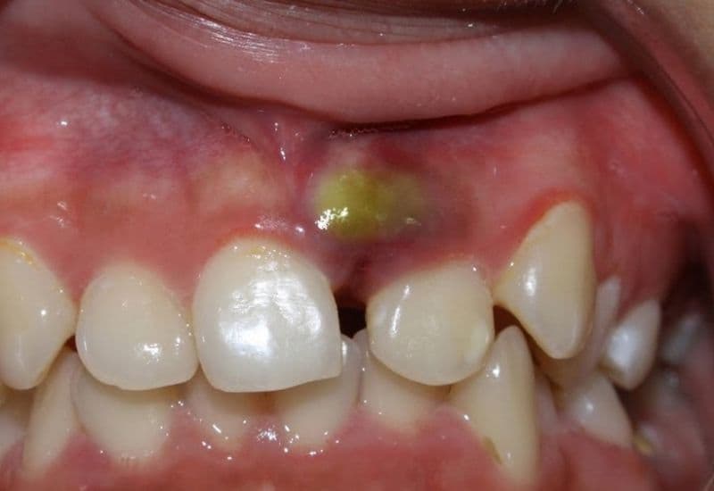 Sưng lợi hàm trên có gây nguy hiểm không