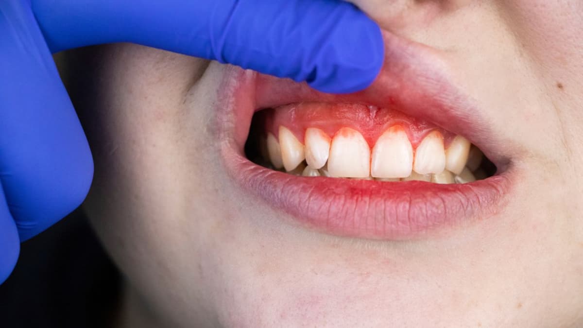 Sưng lợi hàm trên: Cảnh báo bệnh lý răng miệng nguy hiểm
