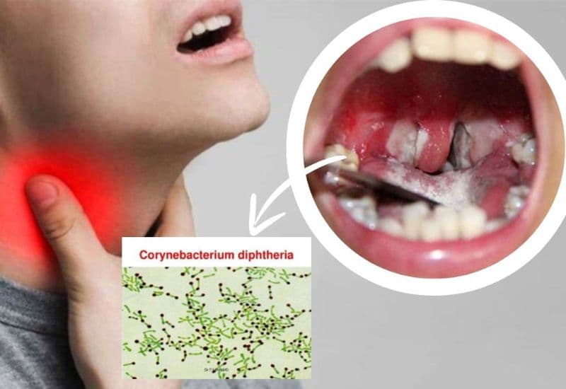 Tại sao cần tiêm bạch hầu