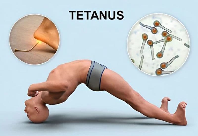 Tiêm ngừa uốn ván phòng bệnh nguy hiểm