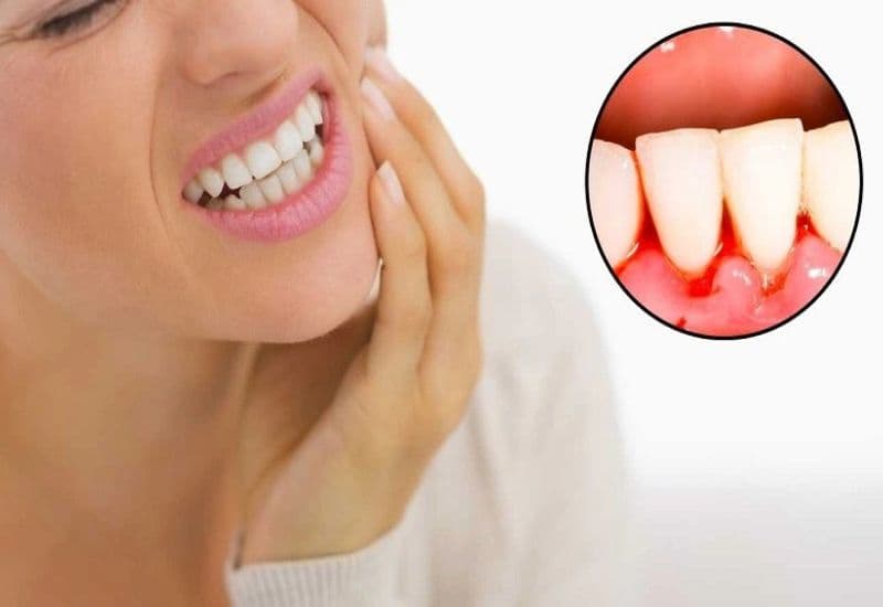 Viêm lợi răng là gì