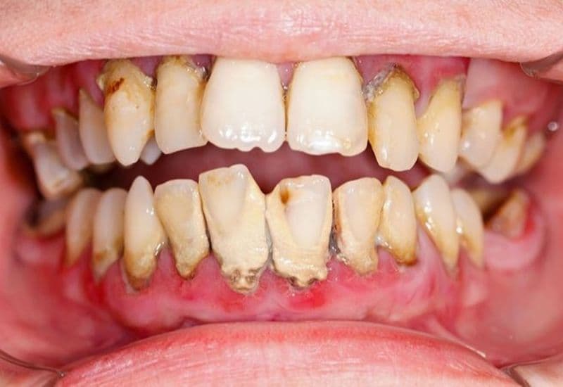 Nguy cơ biến chứng viêm lợi răng