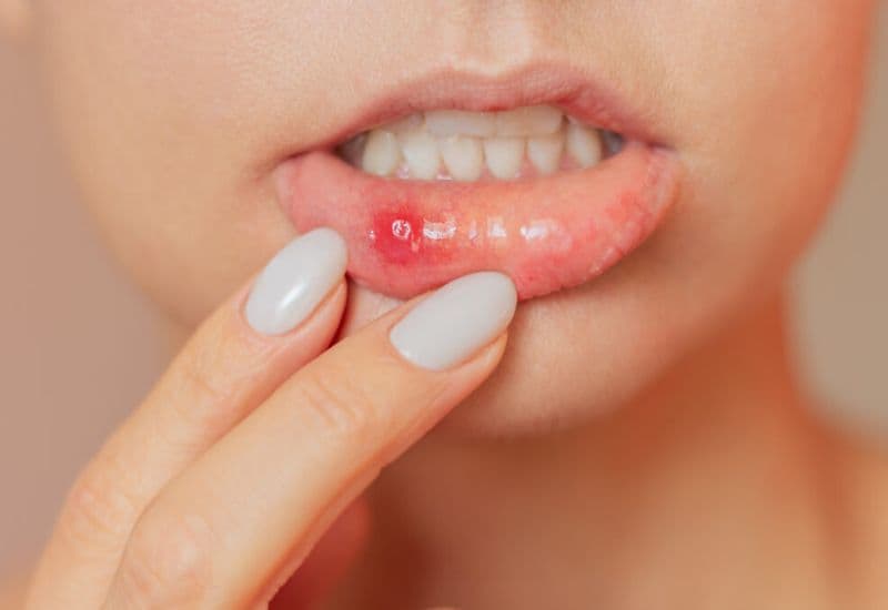 Viêm niêm mạc miệng là gì và có những dạng nào?