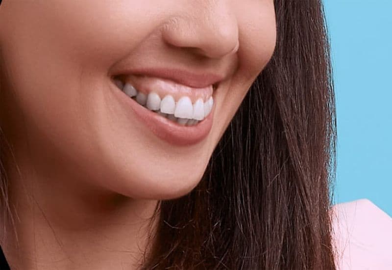 Thế nào là cười hở lợi