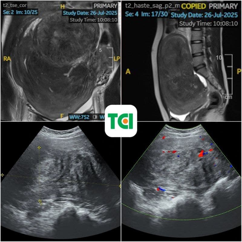 Hình ảnh MRI (phía trên) và siêu âm (phía dưới) cho thấy khối u khổng lồ chiếm toàn bộ ổ bụng.