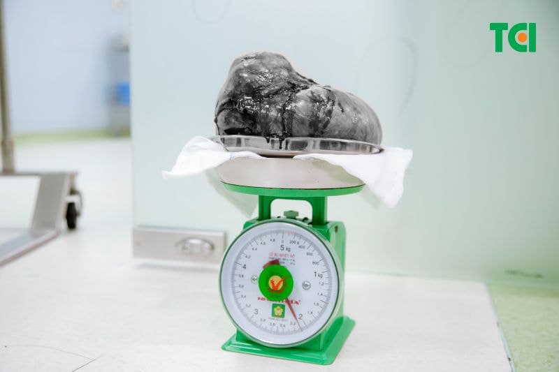 khối u xơ tử cung