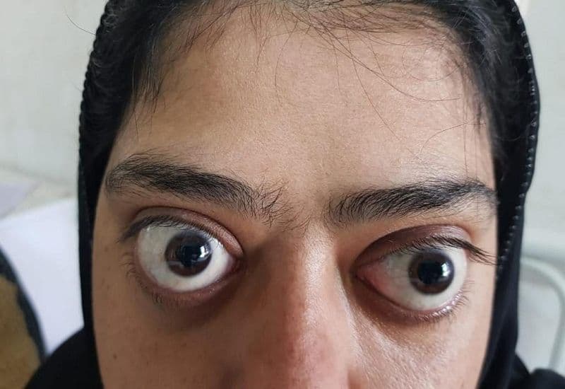 Nguyên nhân dẫn đến tình trạng mắt lồi nhẹ