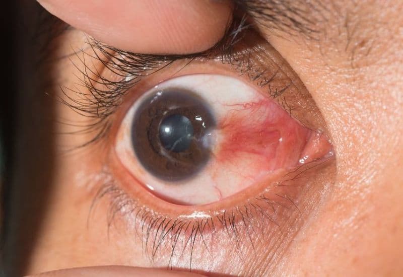 Mộng thịt mắt là gì