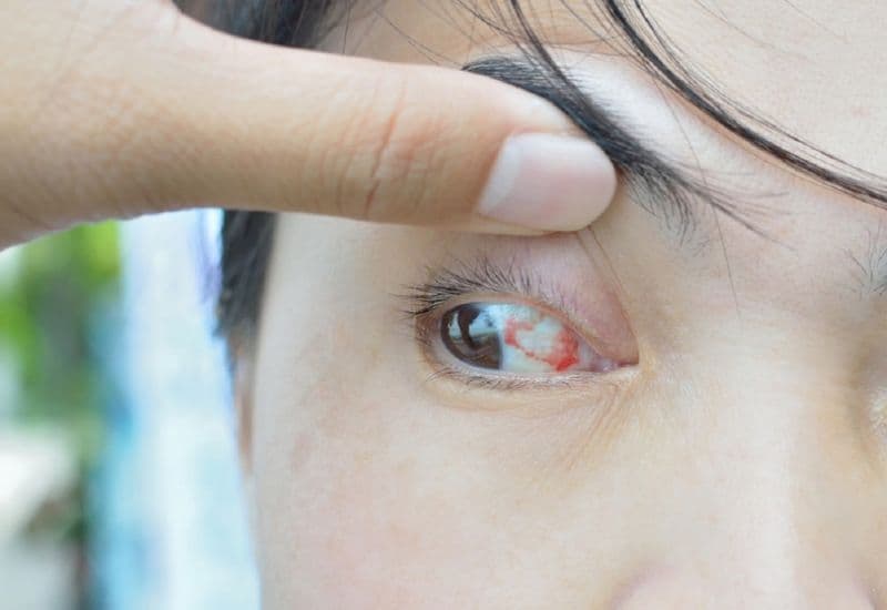 Triệu chứng nhận biết mộng thịt mắt