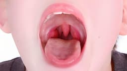 Bệnh lý thường gặp ở niêm mạc miệng và cách phòng tránh