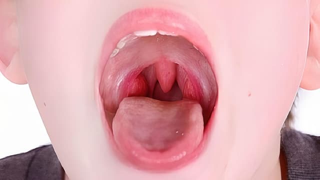 Bệnh lý thường gặp ở niêm mạc miệng và cách phòng tránh