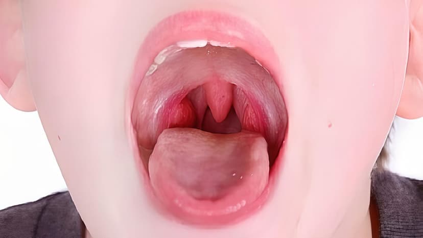 Bệnh lý thường gặp ở niêm mạc miệng và cách phòng tránh