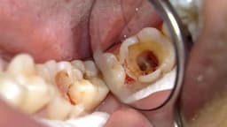 Răng sâu vào tuỷ: Dấu hiệu nhận biết sớm và cách chữa hiệu quả