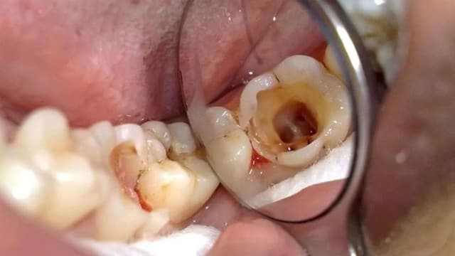 Răng sâu vào tuỷ: Dấu hiệu nhận biết sớm và cách chữa hiệu quả