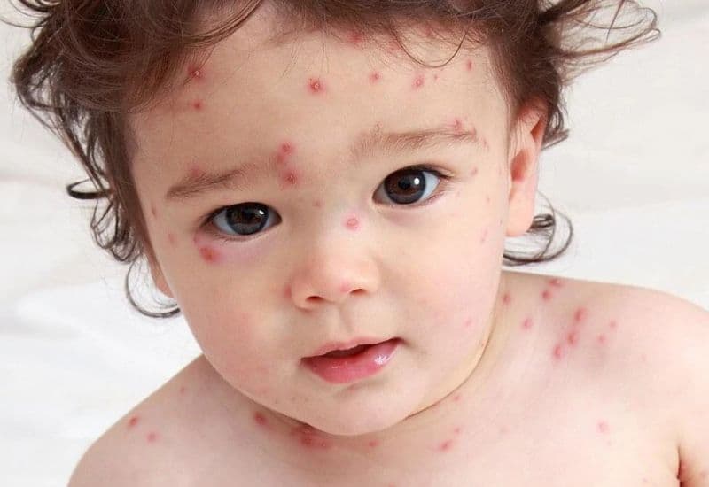 Tác dụng của vacxin thuỷ đậu trong phòng bệnh