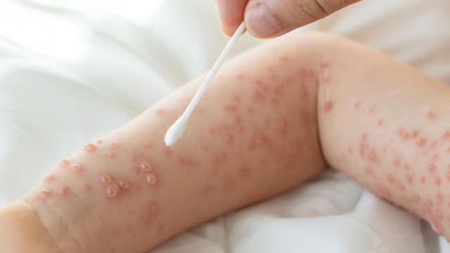 Tiêm vacxin thuỷ đậu bao nhiêu mũi? Lịch tiêm chuẩn mới nhất