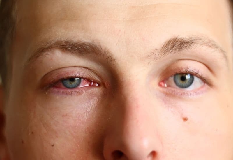 Nguyên nhân thường gặp gây viêm kết mạc cấp