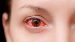 Viêm kết mạc cấp: Dấu hiệu nhận biết sớm và cách điều trị