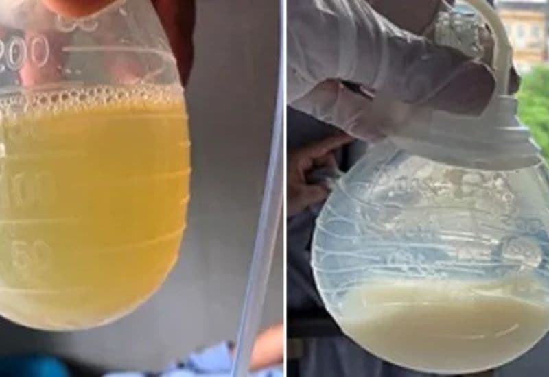 rò dưỡng chấp sau mổ tuyến giáp