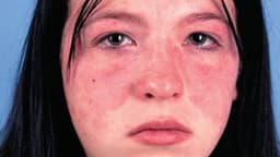 Bị bệnh lupus ban đỏ có mang thai được không?