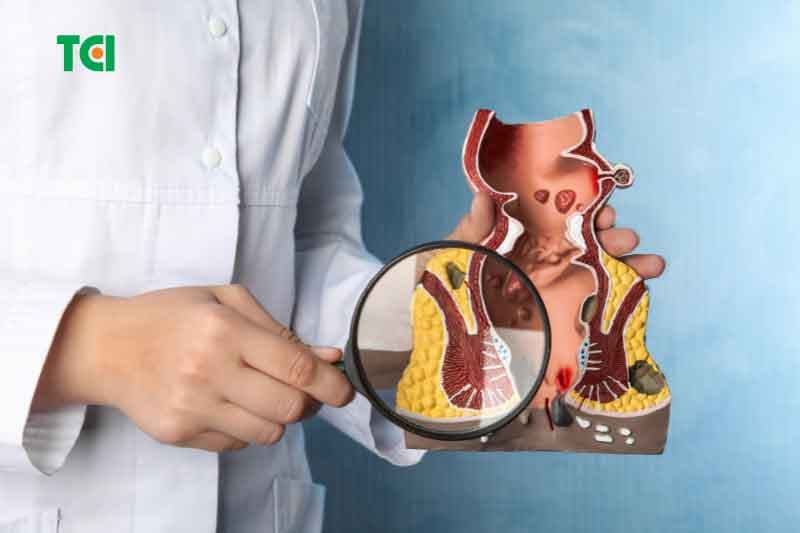 Dầu dừa có trị bệnh trĩ được không?